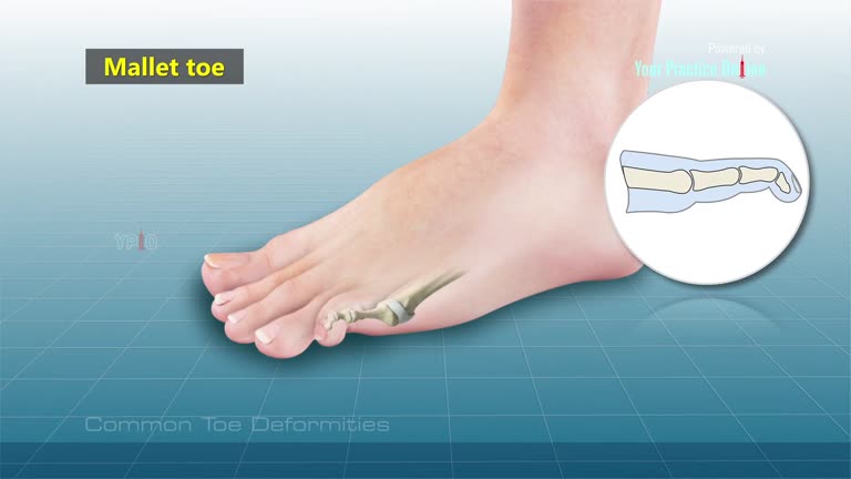 Toe deformities