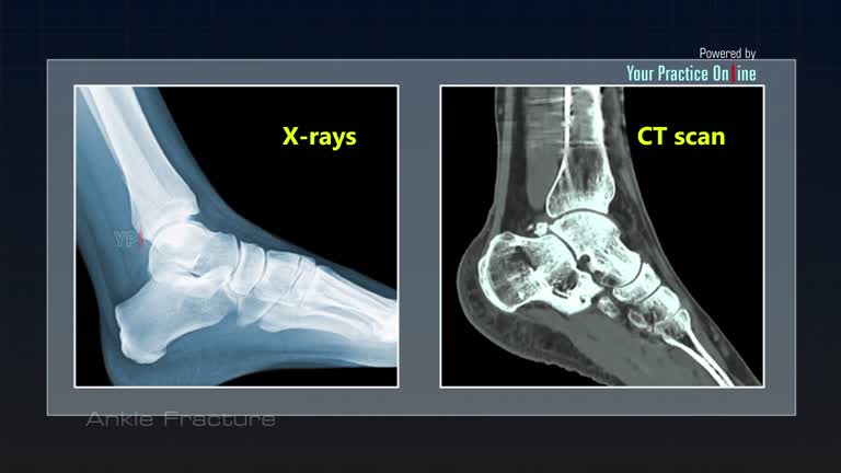 Ankle Fracture - Ankle sprain